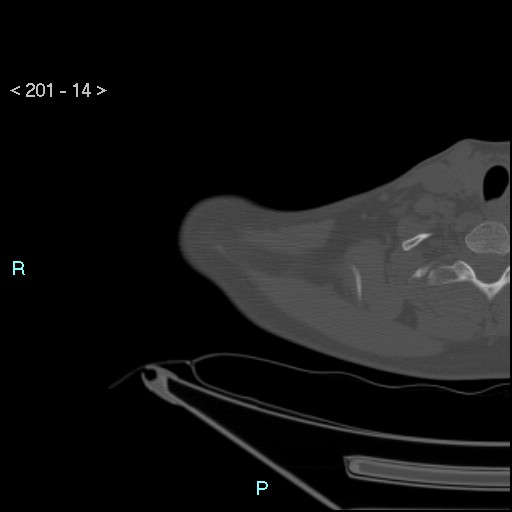 File:Bankart lesion with glenoid bone defect - assessment TC with PICO method (Radiopaedia 42855-93901 Axial bone window 13).jpg