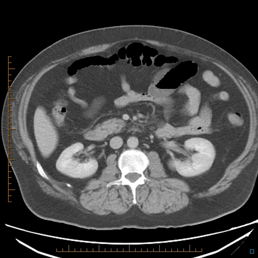 File:Bariatric balloon causing gastric outlet obstruction (Radiopaedia 54449-60672 A 19).jpg