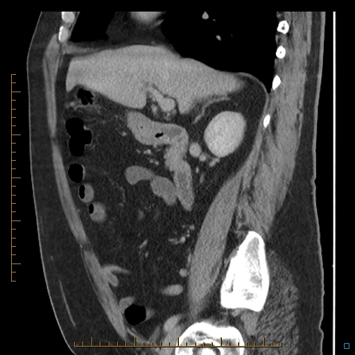 Bariatric balloon causing gastric outlet obstruction (Radiopaedia 54449-60672 C 52).jpg