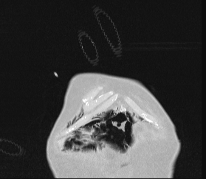 Barotrauma due to mechanical ventilation (Radiopaedia 28079-28336 Coronal lung window 6).jpg