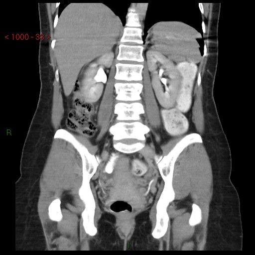 File:Bartholin gland cyst (Radiopaedia 54904-61181 Coronal C+ delayed 33).jpg