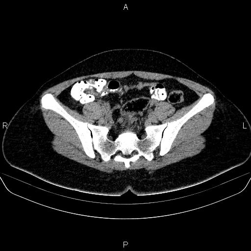 File:Bartholin gland cyst (Radiopaedia 62635-70930 Axial non-contrast 27).jpg