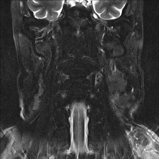 File:Base of tongue squamous cell carcinoma (Radiopaedia 31174-31884 Coronal T2 fat sat 4).jpg