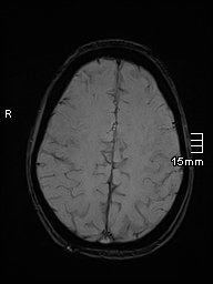 Basilar artery perforator aneurysm (Radiopaedia 82455-99523 Axial SWI 50).jpg