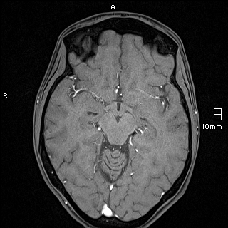 Basilar artery perforator aneurysm (Radiopaedia 82455-99523 F 62).jpg