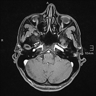 Basilar artery perforator aneurysm (Radiopaedia 82455-99523 G 21).jpg