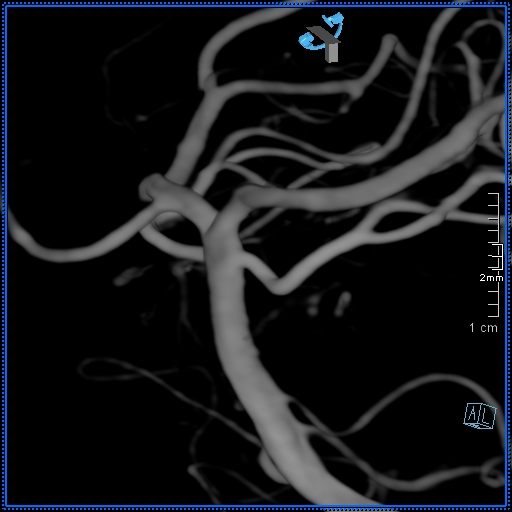 Basilar artery perforator aneurysm (Radiopaedia 82455-99524 3D Left VA 31).jpg
