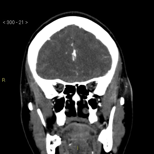 Basilar artery thrombosis (Radiopaedia 16260-15944 B 12).jpg