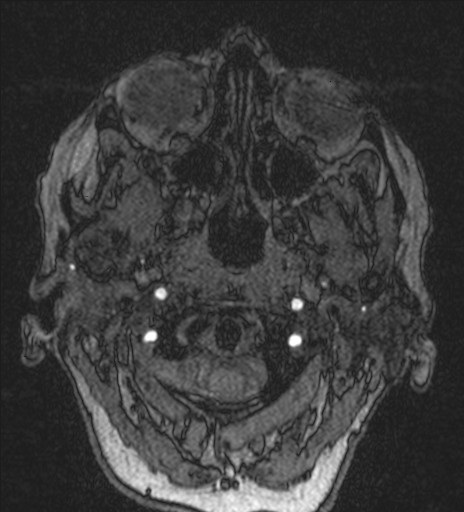 Basilar tip aneurysm (Radiopaedia 26504-26632 MRA 4).jpg