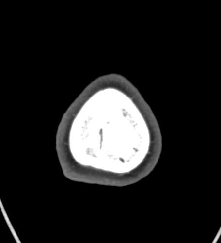 File:Basilar tip aneurysm with coiling (Radiopaedia 53912-60086 A 148).jpg