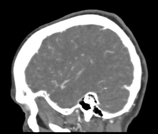 File:Basilar tip aneurysm with coiling (Radiopaedia 53912-60086 C 107).jpg