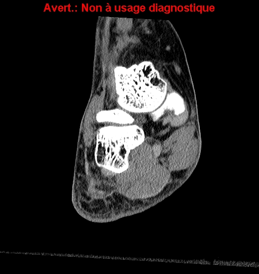 Baxter neuropathy (Radiopaedia 25988-26125 Coronal non-contrast 6).jpg