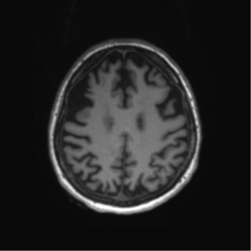 Behavioral variant frontotemporal dementia and late onset schizophrenia (Radiopaedia 52197-58083 Axial T1 24).png