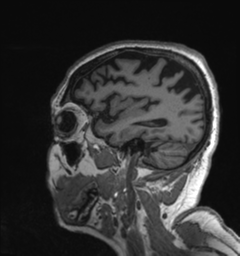 Behavioral variant frontotemporal dementia and late onset schizophrenia (Radiopaedia 52197-58083 Sagittal T1 15).png