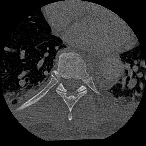 Benign post-traumatic pseudopneumoperitoneum (Radiopaedia 71199-81495 Axial bone window 113).jpg