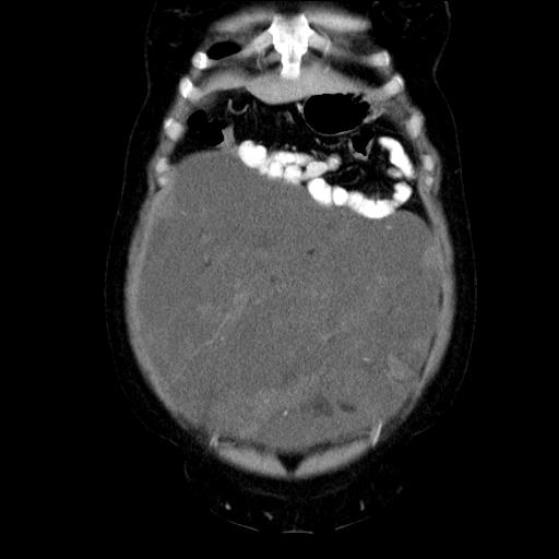 File:Benign spindle cell tumor - abdominopelvic (Radiopaedia 61300-69212 C 14).jpg