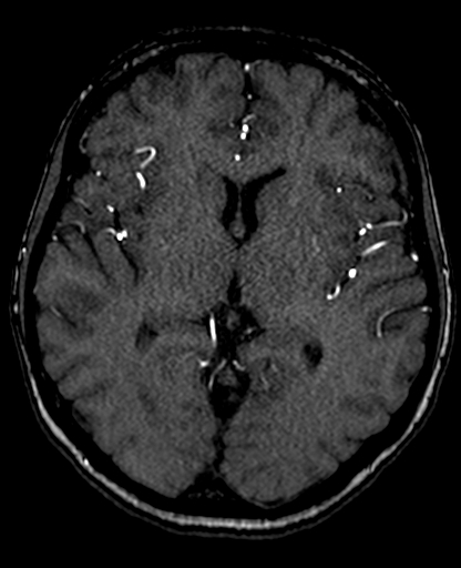 Berry aneurysm of the terminal internal carotid artery (Radiopaedia 88286-104918 Axial TOF 127).jpg