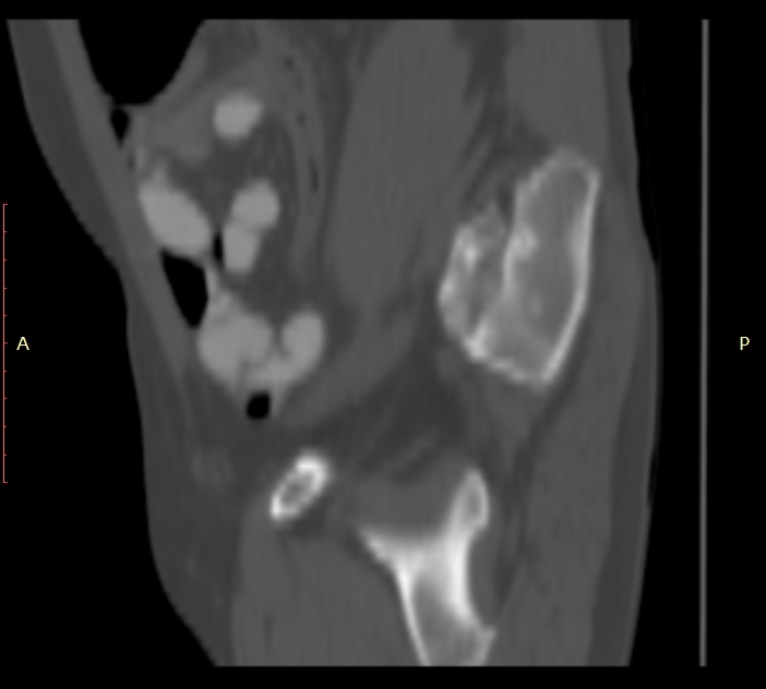 Bertolotti syndrome (Radiopaedia 58974-66235 Sagittal bone window 53).jpg