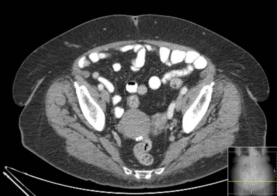 Bicameral celiacomesenteric aneurysm (Radiopaedia 55766-62327 A 59).jpg