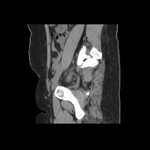File:Bicornuate uterus- on MRI (Radiopaedia 49206-54296 A 4).jpg