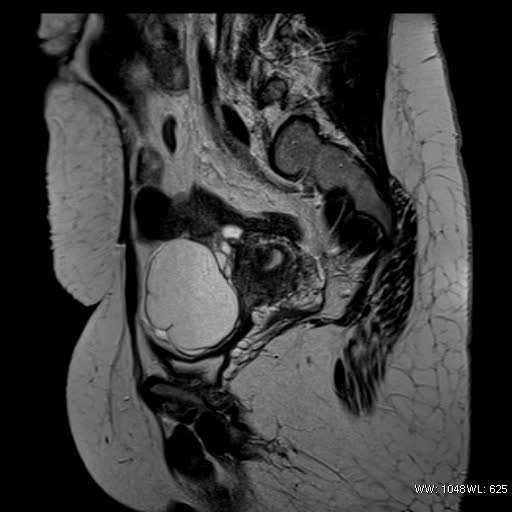 File:Bicornuate uterus- on MRI (Radiopaedia 49206-54297 Sagittal T2 19).jpg