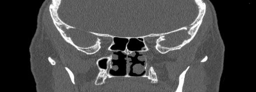 Bilateral Ectopic Infraorbital Nerves (Radiopaedia 49006-54084 Coronal bone window 61).jpg