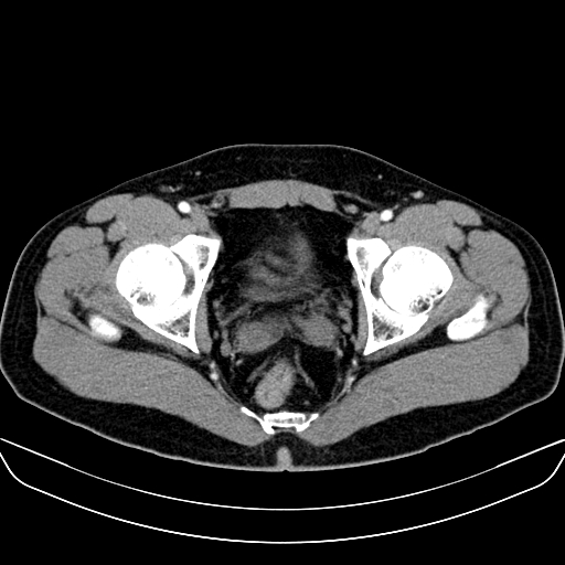 File:Bilateral accessory renal arteries with mild pelvi-ureteric junction (PUJ) obstruction (Radiopaedia 66357-75596 A 70).jpg