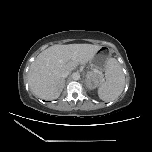 Bilateral adrenal granulocytic sarcomas (chloromas) (Radiopaedia 78375-91007 A 32).jpg