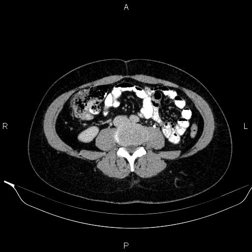 Bilateral adrenal myelolipoma (Radiopaedia 63058-71535 Axial C+ delayed 84).jpg