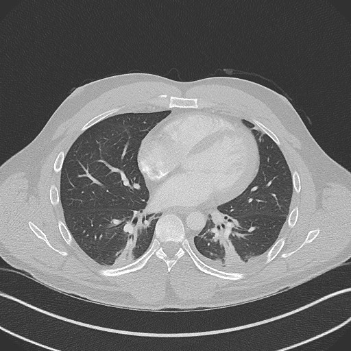 Bilateral atelectasis (Radiopaedia 48666-53675 Axial lung window 68).jpg