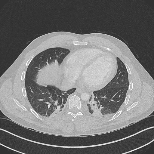 Bilateral atelectasis (Radiopaedia 48666-53675 Axial lung window 77).jpg