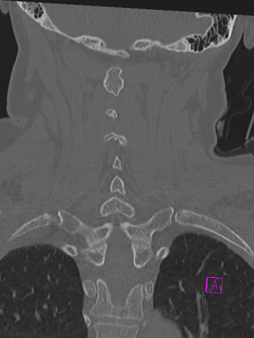 Bilateral atlanto-occipital assimilation (Radiopaedia 28350-28603 Coronal bone window 33).jpg