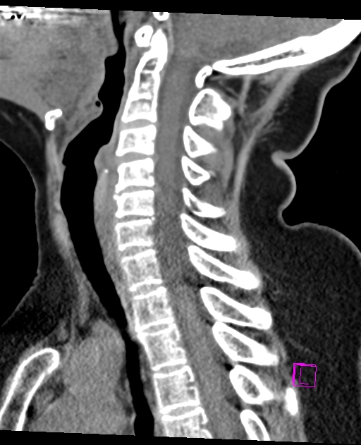 Bilateral atlanto-occipital assimilation (Radiopaedia 28350-28603 D 41).jpg
