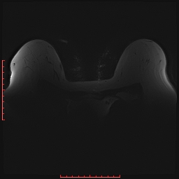 File:Bilateral breast implant rupture (Radiopaedia 24761-25027 PASTA Si 1).jpg