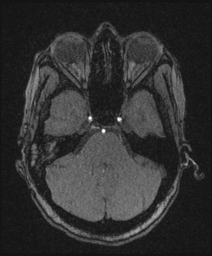 Bilateral carotid body tumors and right glomus jugulare tumor (Radiopaedia 20024-20060 Axial MRA 49).jpg