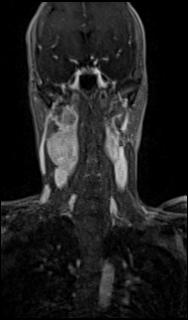 Bilateral carotid body tumors and right glomus jugulare tumor (Radiopaedia 20024-20060 MRA 30).jpg
