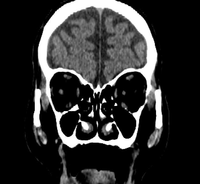 Bilateral ectopia lentis (Radiopaedia 89889-107013 Coronal non-contrast 58).jpg