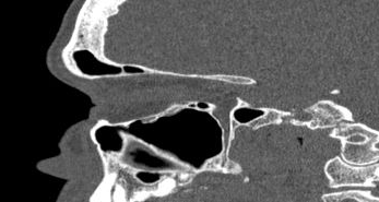 File:Bilateral ectopic infraorbital nerves (Radiopaedia 49006-54084 Sagittal 18).png