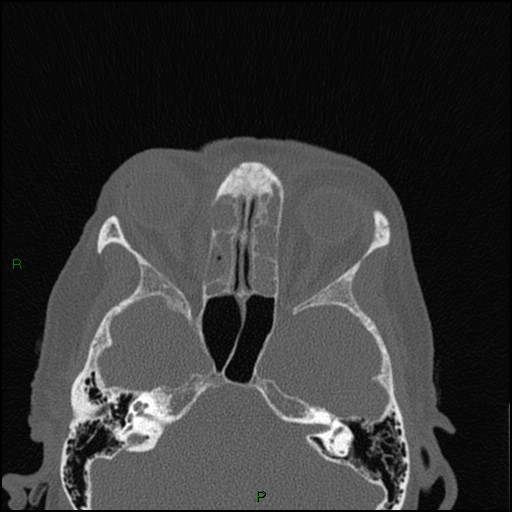 Bilateral frontal mucoceles (Radiopaedia 82352-96454 Axial bone window 140).jpg