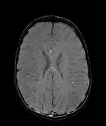 Bilateral mesial temporal polymicrogyria (Radiopaedia 76456-88181 Axial SWI 44).jpg