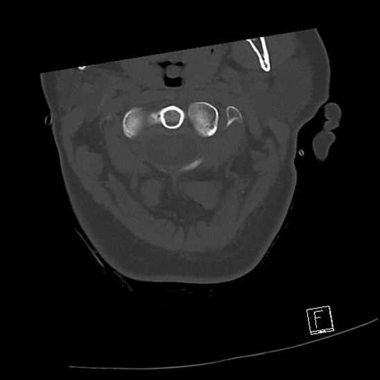 Bilateral occipital condyle fractures (type 3) (Radiopaedia 87672-104086 Axial bone window 19).jpg