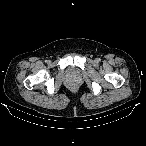 Bilateral ovarian dermoid cysts (Radiopaedia 85785-101603 A 109).jpg