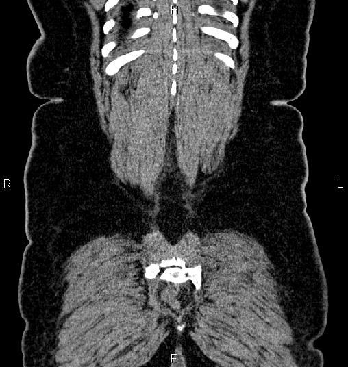 Bilateral ovarian dermoid cysts (Radiopaedia 85785-101603 C 58).jpg