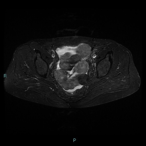 File:Bilateral ovarian fibroma (Radiopaedia 44568-48293 Axial STIR 16).jpg