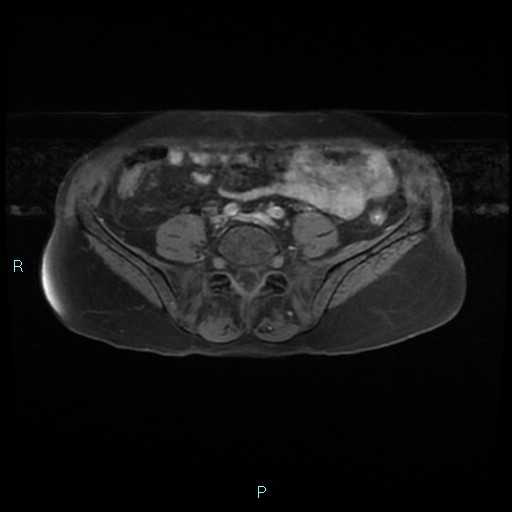 File:Bilateral ovarian fibroma (Radiopaedia 44568-48293 Axial T1 fat sat 1).jpg