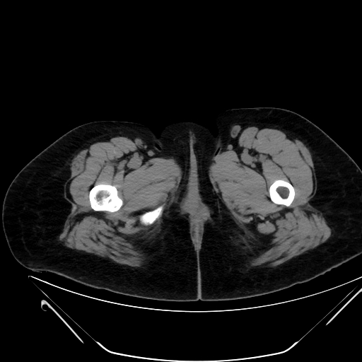 Bilateral ovarian mature cystic teratomas (Radiopaedia 79373-92457 Axial non-contrast 109).jpg