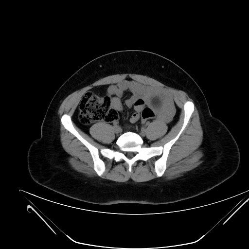 File:Bilateral ovarian mature cystic teratomas (Radiopaedia 79373-92457 Axial non-contrast 43).jpg