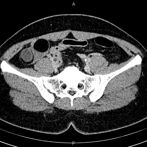 Bilateral ovarian teratoma (Radiopaedia 83131-97503 B 23).jpg