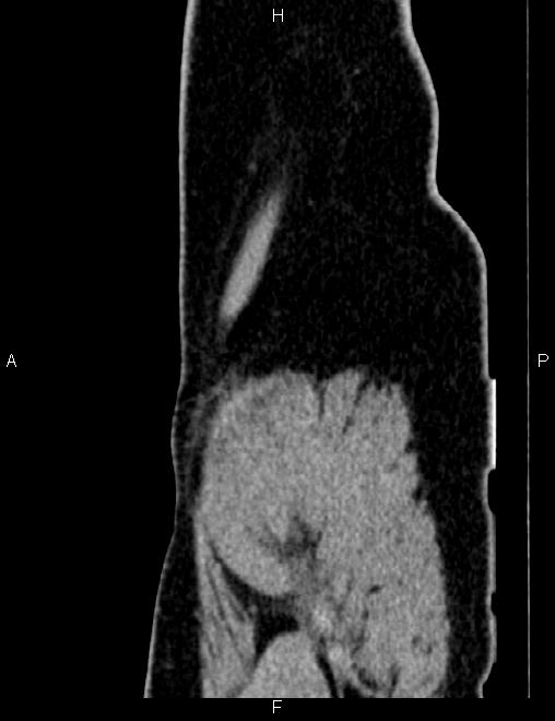 Bilateral ovarian teratoma (Radiopaedia 83131-97503 D 109).jpg