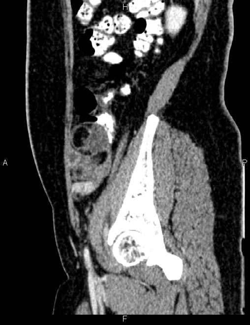 Bilateral ovarian teratoma (Radiopaedia 83131-97503 D 38).jpg